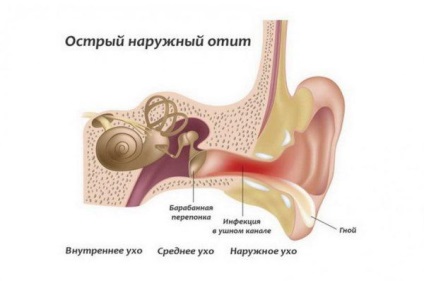 Inflamația tratamentului urechii la domiciliu cu remedii folclorice, medicamente cu antibiotice, picături