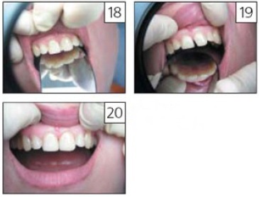 Restaurarea cavităților volumetrice ale grupurilor centrale și laterale ale dinților cu flux de fluid nou
