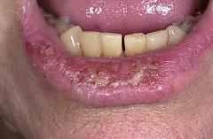 Heilit az ajkakon - kezelés, tünetek, típusok