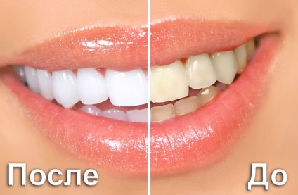 Albirea chimică a dinților