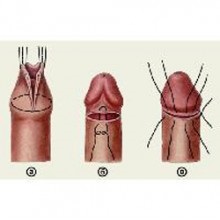 Felnőttek és gyermekeknél a phimosis sebészeti működése, fotó, műtét ára, nagy Novgorod