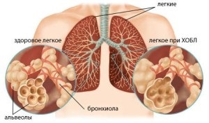 Boala pulmonară obstructivă cronică