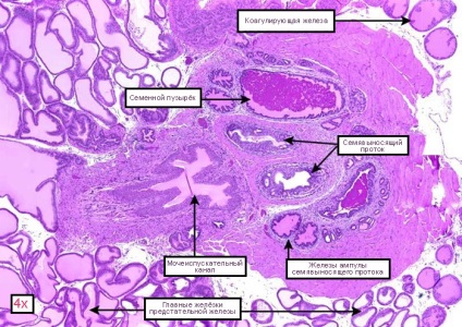 Hiperplazia prostatică glandular-stromală provoacă, simptome, tratament