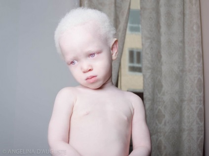20 de oameni albini uciși, izbitoare de aspectul lor, umkra