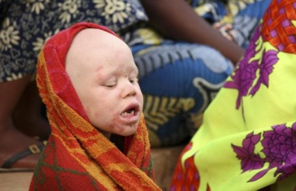 Africa de vânătoare pentru albinos - ghicitori omului - știri