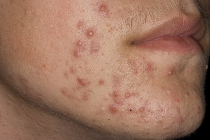 Acnee - cauzele acneei acnee, stadiul de dezvoltare a acneei, metodele de tratare a acneei