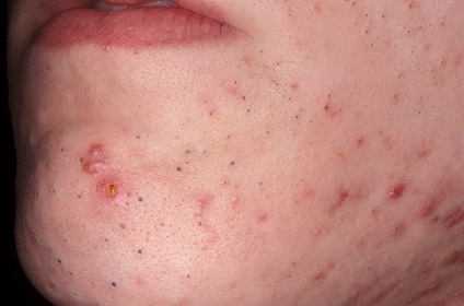 Acnee - cauzele acneei acnee, stadiul de dezvoltare a acneei, metodele de tratare a acneei
