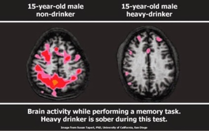 Alcoolul și creierul sunt influențate de consumul excesiv de alcool pe blogul cognifit al sistemului nervos