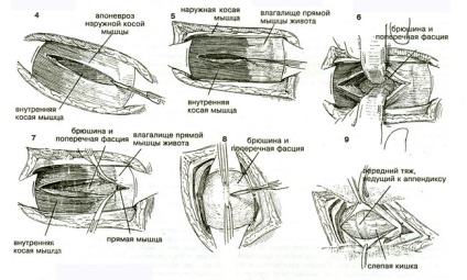 Allsurgery - tratamentul apendicitei acute