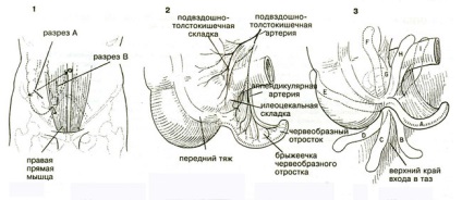 Allsurgery - tratamentul apendicitei acute