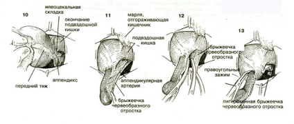 Allsurgery - tratamentul apendicitei acute