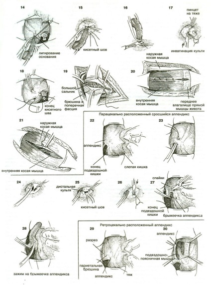 Allsurgery - tratamentul apendicitei acute