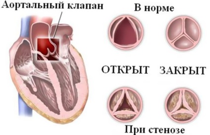 Stenoza aortică a inimii, medicină populară