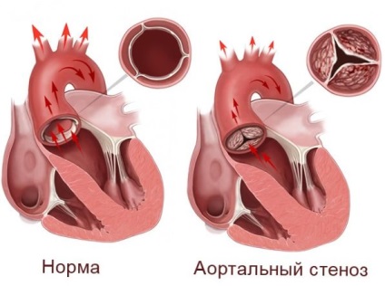 Stenoza aortică a inimii, medicină populară