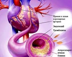 Ateroscleroza - tratamentul aterosclerozei prin metode și metode populare