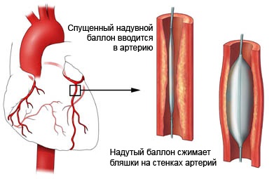 Balon angioplastie - prețuri, normă, decodare, pregătire, contraindicații