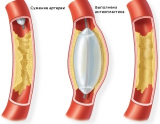 Balon angioplastie - prețuri, normă, decodare, pregătire, contraindicații