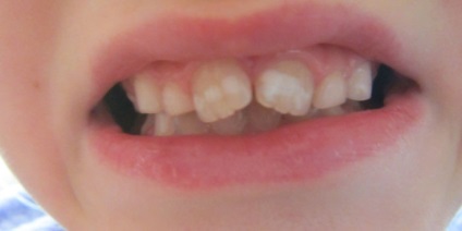 Placa albă pe dinți lângă gingii - motivele pentru apariția și cum se scarpină copilul