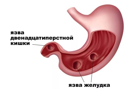 Tratamentul rapid și eficient al ulcerului trofic cu remedii folclorice la domiciliu