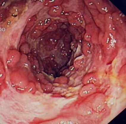 Boala coronară a intestinului subțire (intestinul subțire)