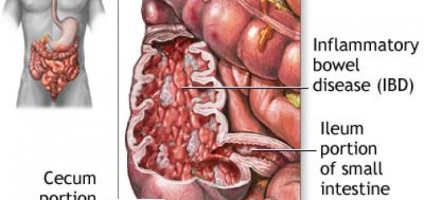 Boala coronară a intestinului subțire (intestinul subțire)