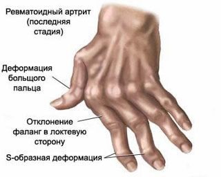 Durere de încheietura mâinii, etiologie, simptome suplimentare, tratament