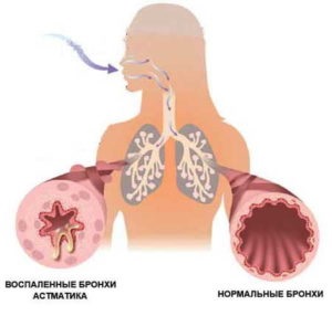 Bronșita și astmul din viermele cauzei, caracteristici ale tratamentului