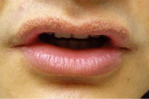 Ce să faceți dacă buza este umflată de herpes