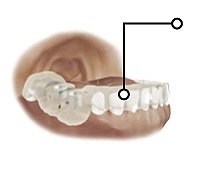 Ce este un șablon chirurgical? Totul despre șabloanele chirurgicale