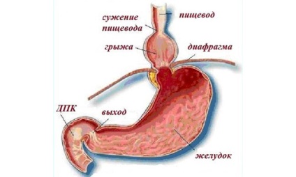 Simptome și tratament pentru hernia diafragmatică