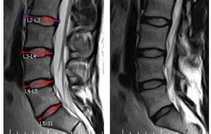 Hernia dorsală a cauzelor discului cervical, simptomele și tratamentul