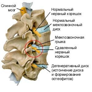 Hernia dorsală a cauzelor discului cervical, simptomele și tratamentul