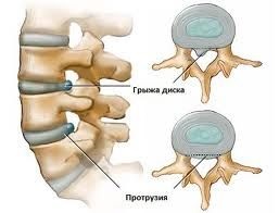 Hernia dorsală a cauzelor discului cervical, simptomele și tratamentul