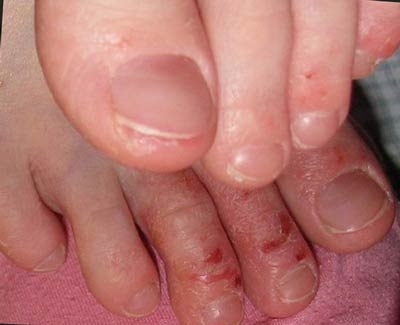 Eczemele pe picioare cauze, tipuri, cum să tratăm