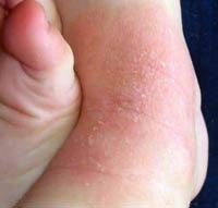 Eczemele pe picioare cauze, tipuri, cum să tratăm