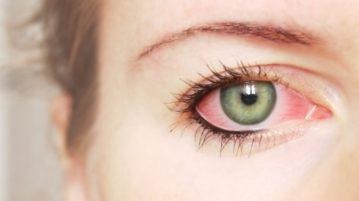 Endoftalmită Iritarea irisului - simptome și tratamentul purulent