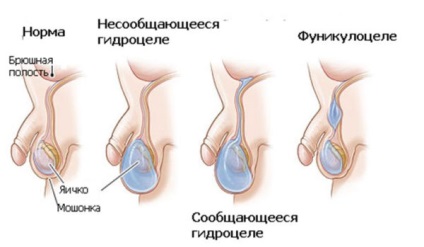 Funicularo este picătura cordonului spermatic, este această definiție adevărată, precum și