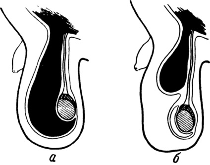 A Funicularo a spermatopuska cseppje, ez a meghatározás igaz, csakúgy, mint