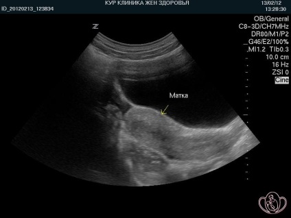 Infantilismul genital