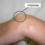 Hygroma articulației genunchiului și tratamentul acesteia la copii și adulți