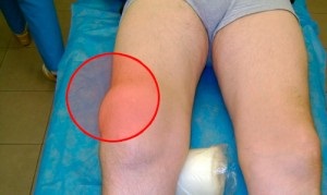 Hygroma articulației genunchiului și tratamentul acesteia la copii și adulți