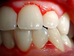 Gingivita și parodontita la copii, tratamentul gingivitei și parodontitei la copii