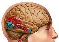 Malformațiile creierului - vascular