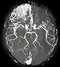 Malformațiile creierului - vascular