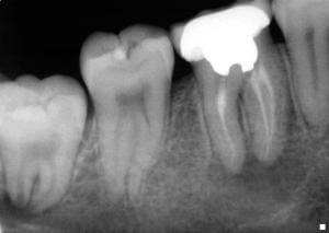 Granuloma simptome dinte, tratament, prevenire