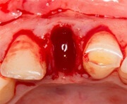 Irigator pentru cavitatea orală ld a7