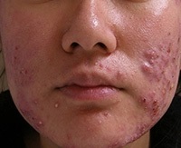 Cum sa scapi de masca de acnee, unguent si un salicilic unguent pentru tratamentul acneei