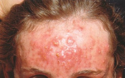 Cum sa scapi de masca de acnee, unguent si un salicilic unguent pentru tratamentul acneei