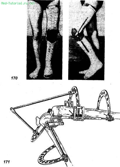 Contractele și anchiloza, complicațiile fracturilor și dislocațiilor, traumatologia, literatura medicală,