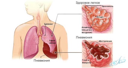 Stadiul pneumoniei cronice, simptome, prevenire și tratament